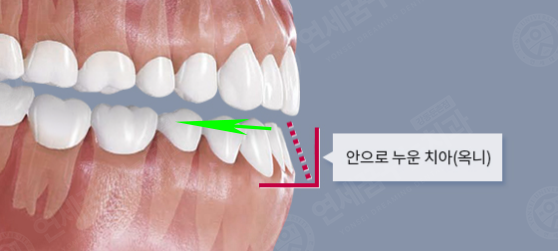 5. 방이동 돌출입교정 앞니가 과도하게 안으로 기울어진 옥니 비교 이미지