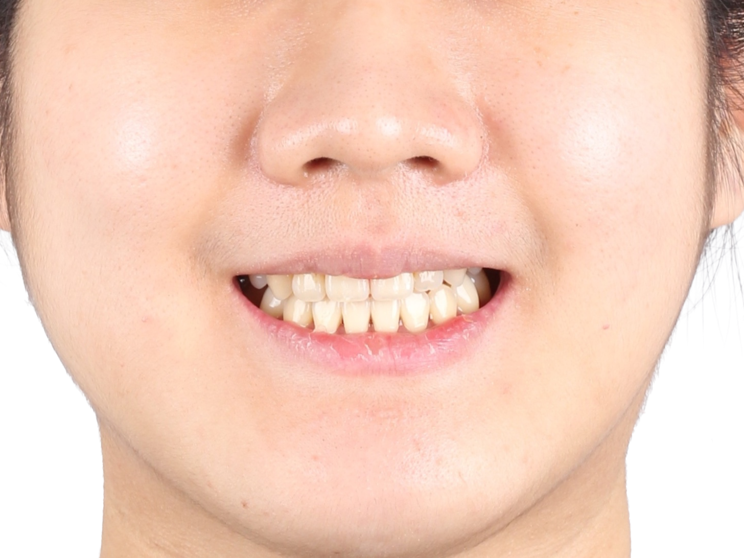 주걱턱 (수술) 사례 01 얼굴 정면 치료 후